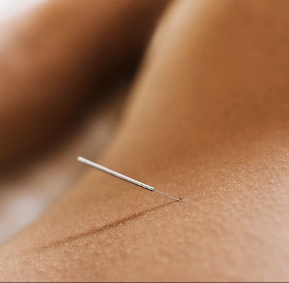 Thérapie manuelle & dry needling